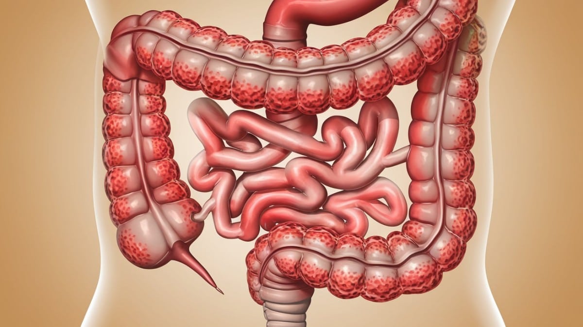 Intestin humain en inflammation